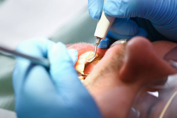 Best Emergency Treatment for Dental Infections or Abscesses in Columbus, MN