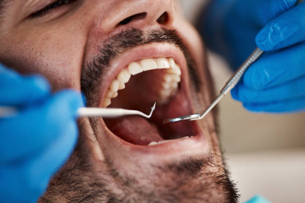Best Emergency Tooth Extraction in Columbus, MN