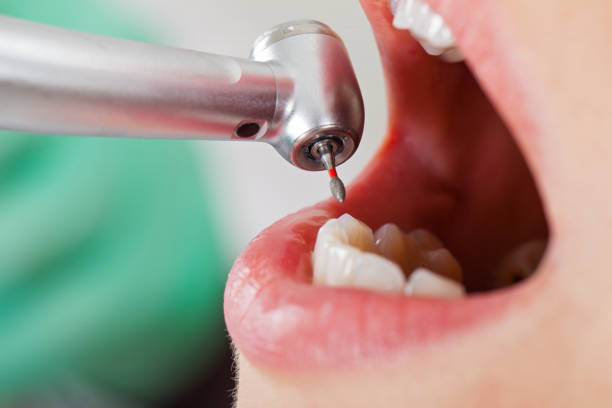 Best Emergency Tooth Extraction in Columbus, MN